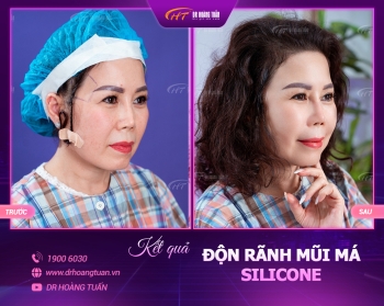 ĐỘN RÃNH MŨI MÁ